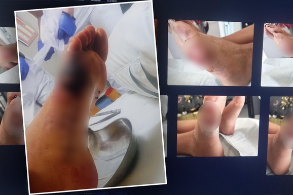SASLUŠANI DOKTOR I KOZMETIČAR Žena otišla na rutinski tretman, pa završila sa stravičnim povredama stopala, evo kako su se branili